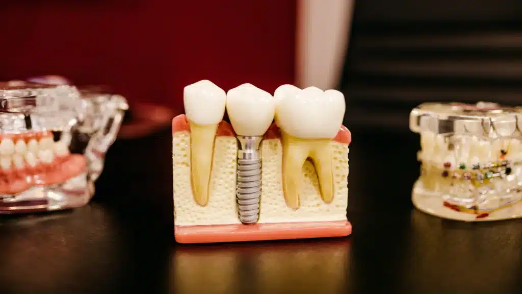 Dental Implants Top Smile Dental Clinic
