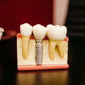 Dental Implants in Dubai at low cost by Top Smile Dental Clinic | Dental Implant Dubai