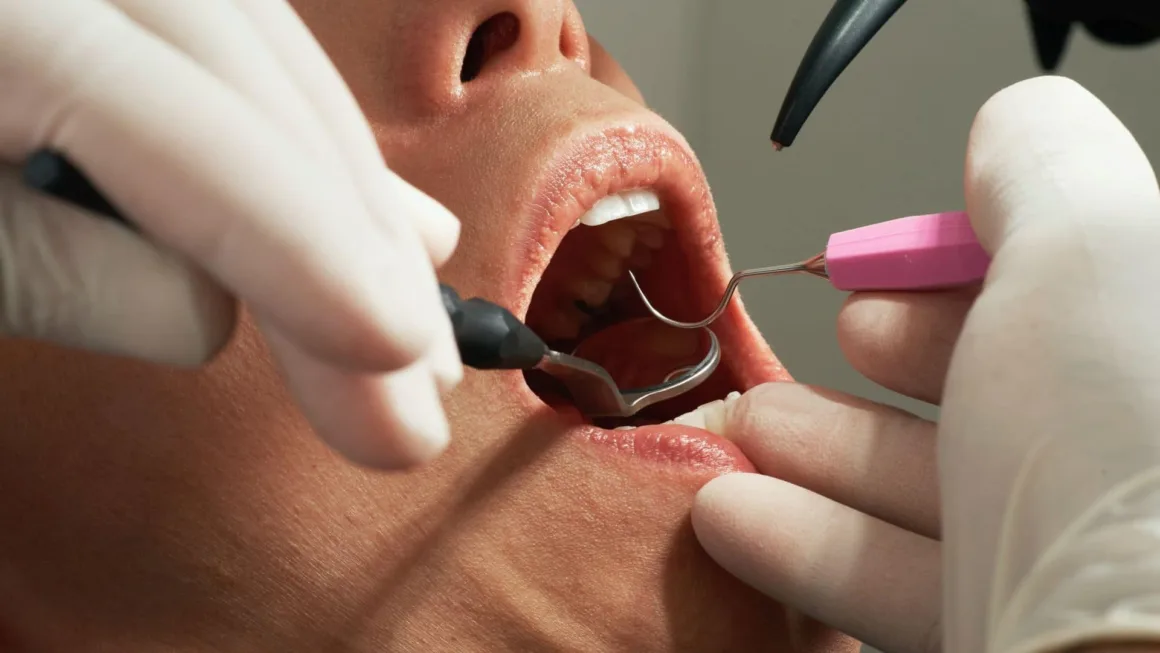 treatment-of-dental-caries treatment of dental caries and tooth decay | dubai dental studio