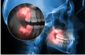 Wisdom Tooth Extraction Dubai