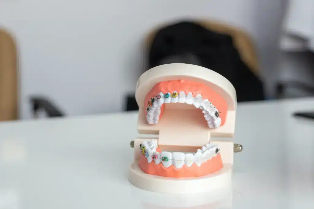 dental braces and teeth aligners | dental clinic in satwa