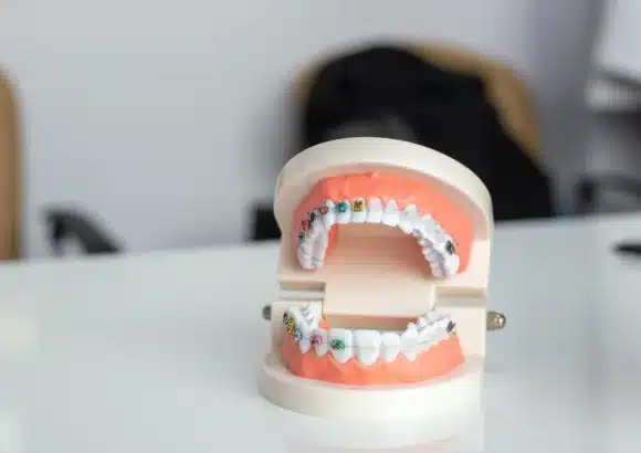 dental braces and teeth aligners | dental clinic in satwa