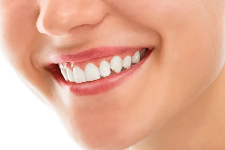 hollywood teeth at Top Smile Dental Clinic in Oud metha Dubai. Your Hollywood smile makeover clinic in Dubai