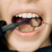 Does everyone has wisdom teeth? How many wisdom teeth a person has? Are wisdom teeth genetic?