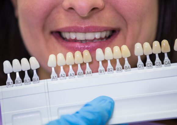 How Dental Veneers Can Solve Your Teeth-Related Problems?