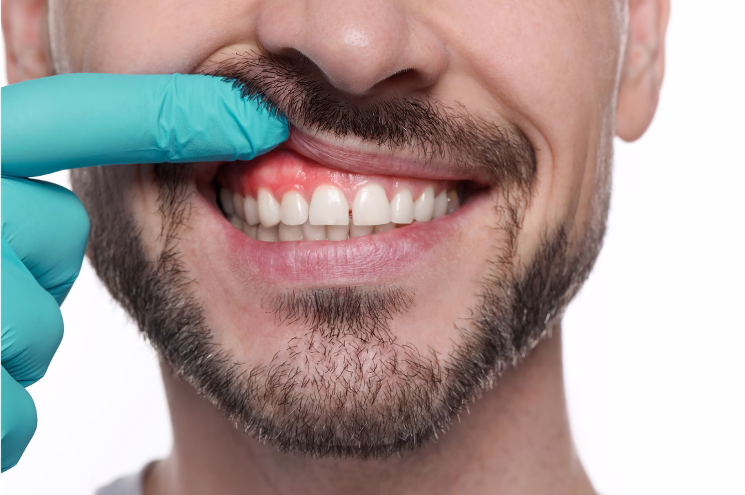 gum disease treatment | affordable dental clinic in dubai