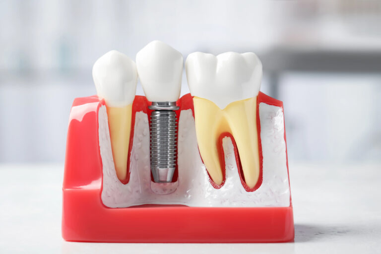 Dental implant surgery by specialist