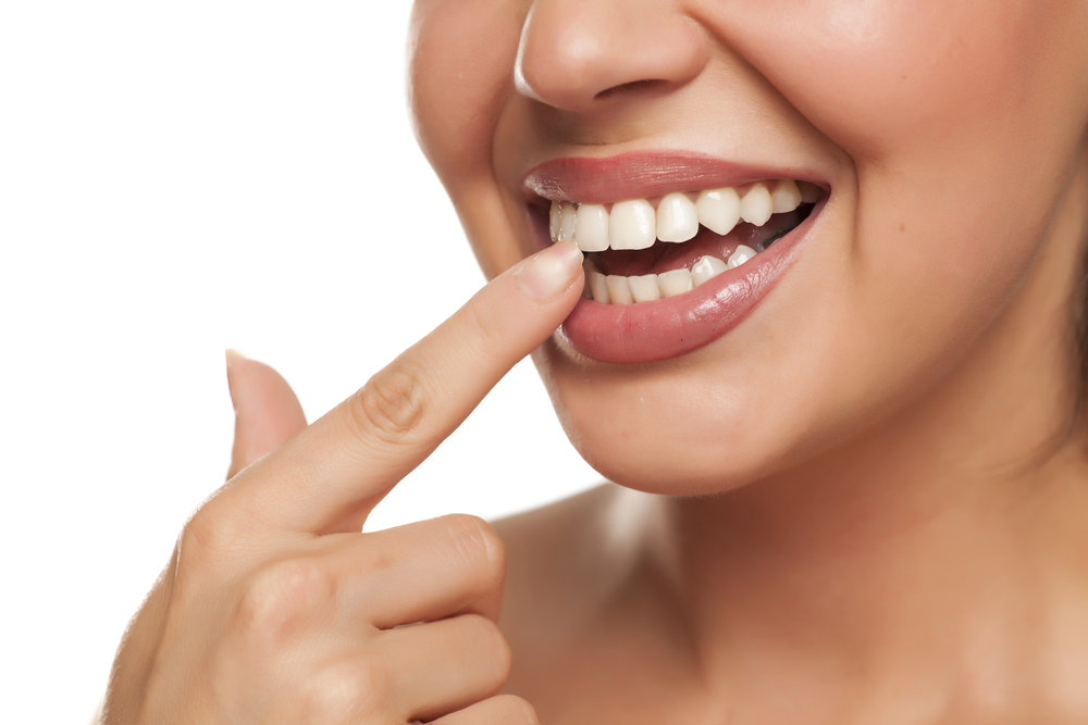 Hollywood Smile makeover at Top Smile Dental Clinic Dubai