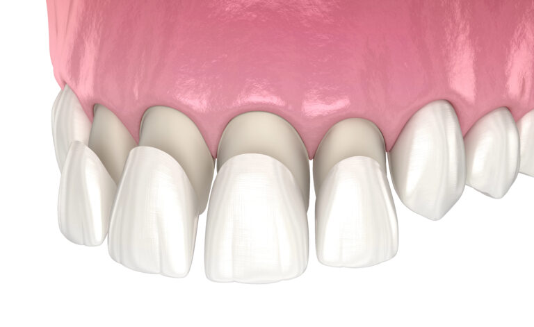 Porcelain veneers procedure at dental clinic