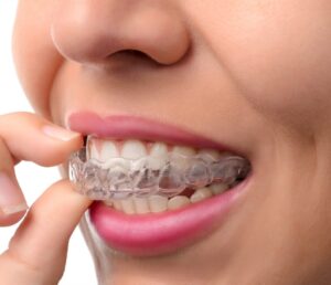 Invisalign Treatment Dubai