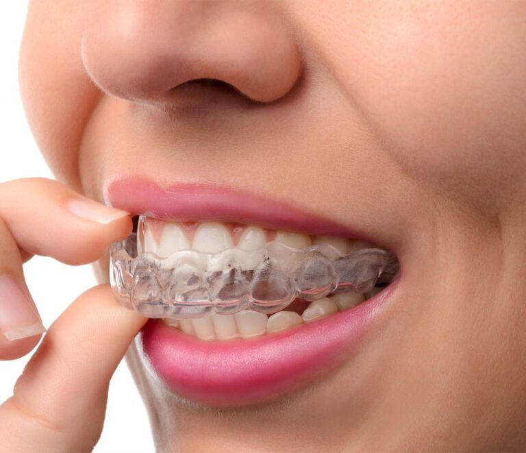 Invisalign clear aligners for teeth straightening