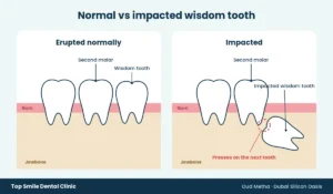 Impacted wisdom tooth vs normal diagram